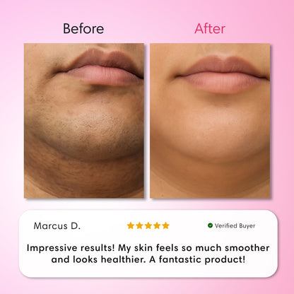 Stop the Cycle of Unwanted Hair Regrowth ✨ Smooth Skin Made Simple （Hair Removal Trilogy Kit）