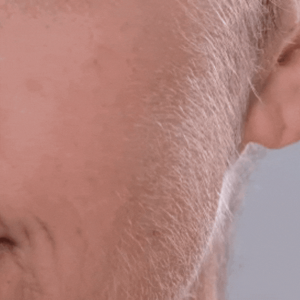 LUMIVO mechanism - follicular deactivation